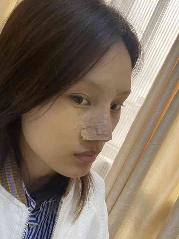 四川省成都軍建醫(yī)院怎么樣？2021價(jià)格表曝光+隆鼻真人案例分享