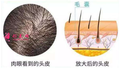 頭發(fā)種植效果可靠嗎？術(shù)前注意事項大全！