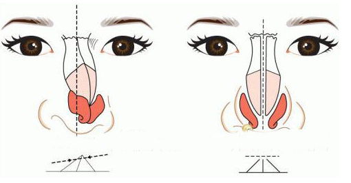 歪鼻子矯正后會(huì)留下疤痕嗎?
