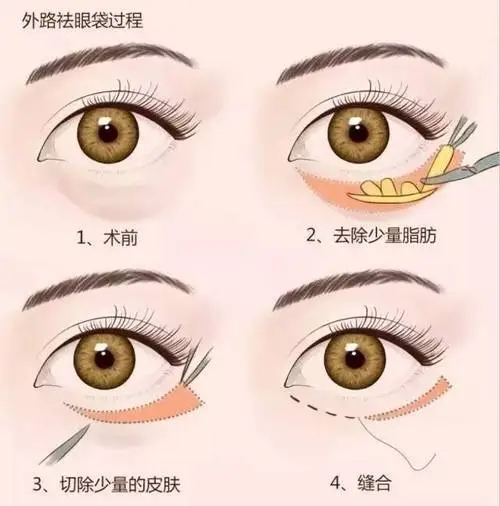 疤克能防止疤痕增生嗎? 疤克能防止疤痕增生嗎?