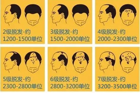 北京頭發(fā)移植醫(yī)院有哪幾家?怎么選擇?