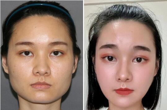 北京面部輪廓下頜角顴骨內(nèi)推降低手術(shù)醫(yī)院醫(yī)生推薦