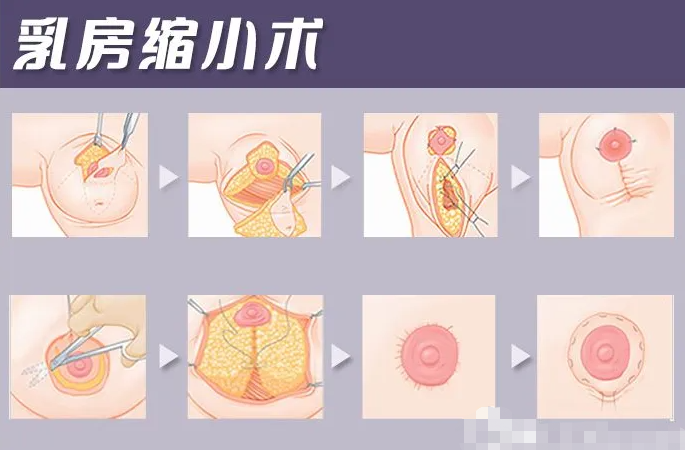 多大可以做乳房縮小手術(shù)，哪些情況適合做乳房縮小手術(shù)?