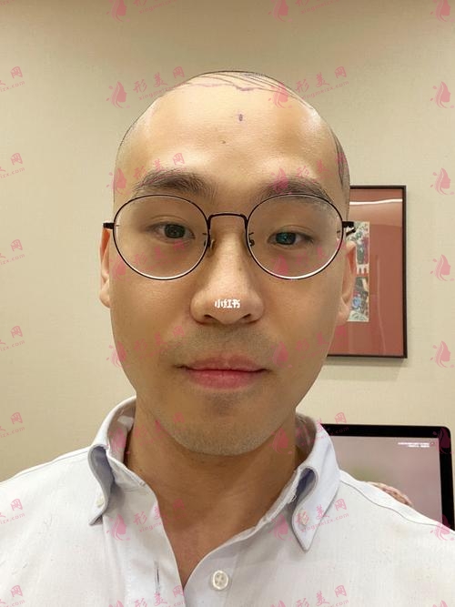 上海九院植發(fā)價(jià)格