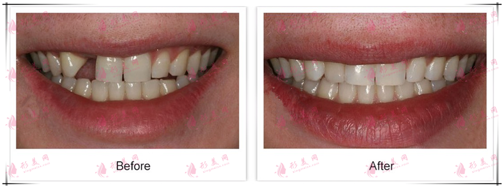 上海九院口腔科種植牙案例