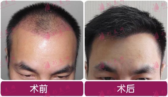 國(guó)內(nèi)植發(fā)一般是什么價(jià)格？看看植發(fā)多少錢一個(gè)單位