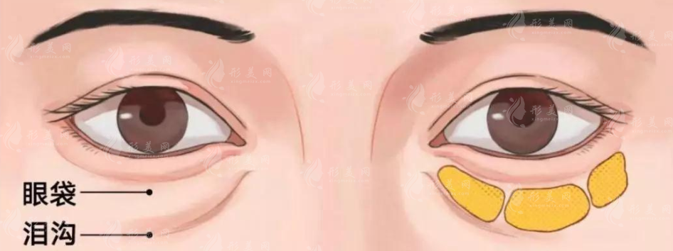 不開刀去眼袋費用高不高? 不開刀去眼袋費用高不高?