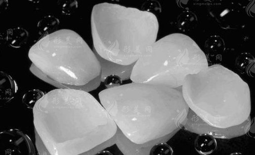 牙齒貼面的費(fèi)用貴不貴呀?