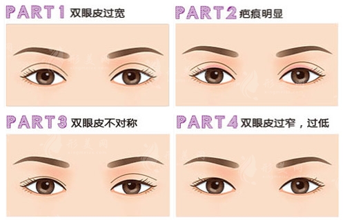 雙眼皮修復(fù)術(shù)后要注意什么？