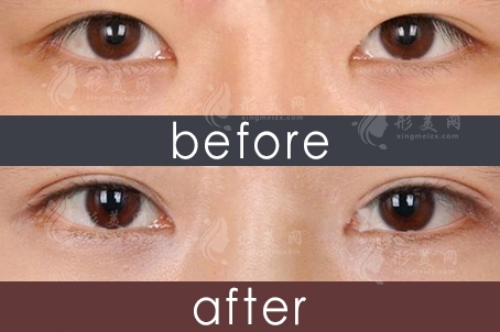 雙眼皮修復(fù)大概多少錢呢？為什么修復(fù)要上萬(wàn)？難度很大嗎？