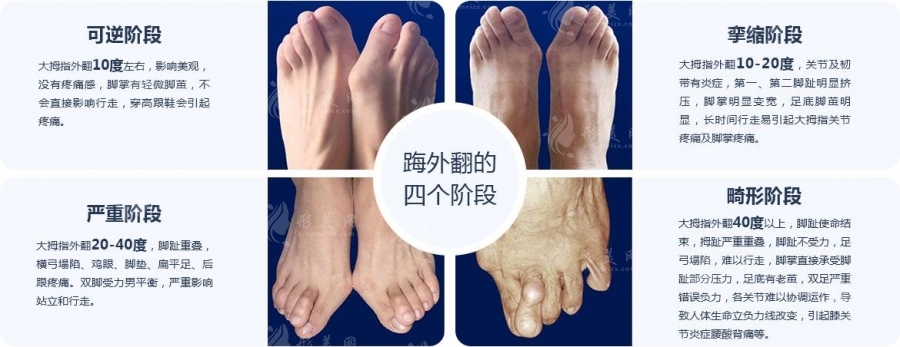 溫建民拇外翻微創(chuàng)手術(shù)多少錢？相比馬桂文做大腳骨收費(fèi)誰(shuí)更高？