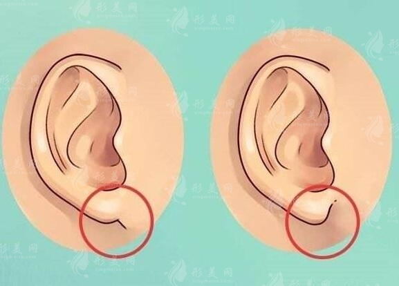 北京八大處耳再造費(fèi)用多少錢(qián)