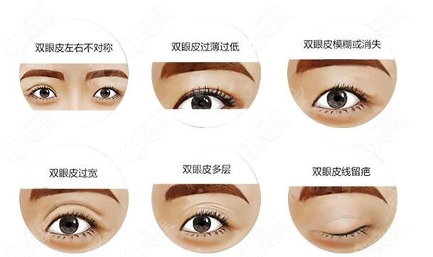 上海杜園園修復(fù)雙眼皮多少錢？坐診醫(yī)院+顧客反饋及價格一覽