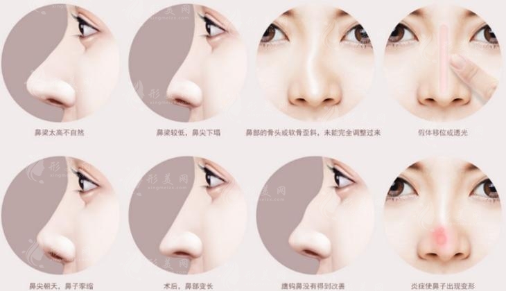 重慶李喆做高難度鼻修復(fù)-鼻再造技術(shù)底蘊深厚