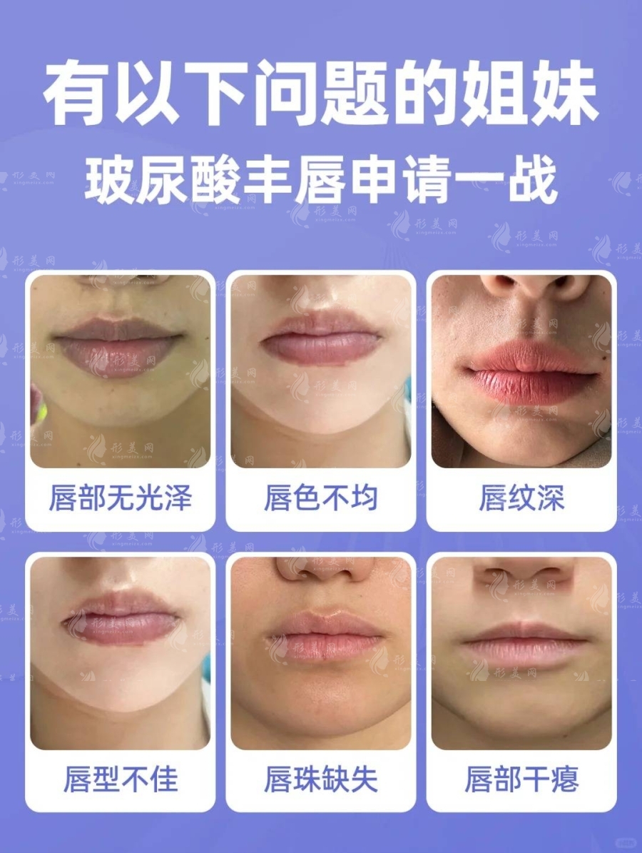 北京玻尿酸豐唇價格多少：4230~16850元起