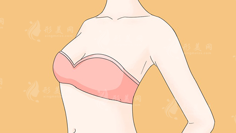 假體隆胸 假體隆胸