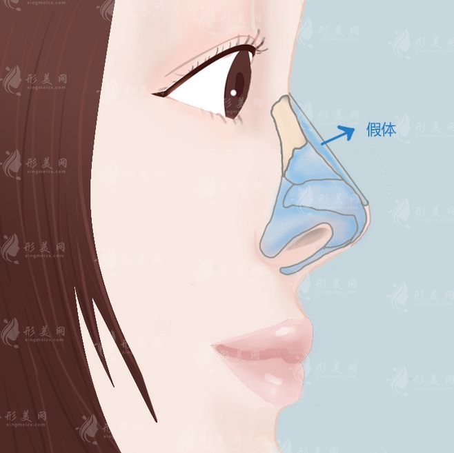 假體隆鼻手術(shù)