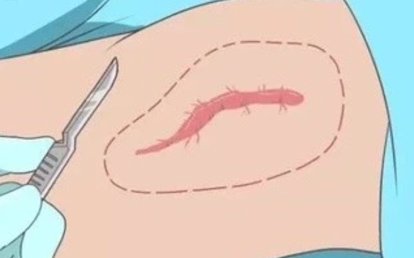 疤痕整形一般要多少錢？手術貴嗎？