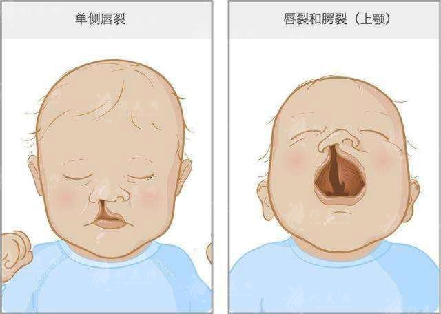 兔唇會(huì)遺傳嗎