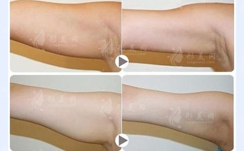 手臂吸脂手術(shù)