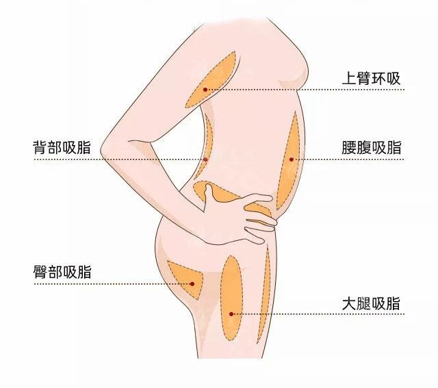 北京顧云鵬手臂吸脂手術(shù)費(fèi)用多少錢？附新價(jià)格表