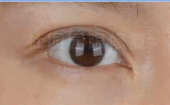 內(nèi)眼角失敗，疤痕明顯？選上海愛(ài)尚麗格讓你找回完美肌膚