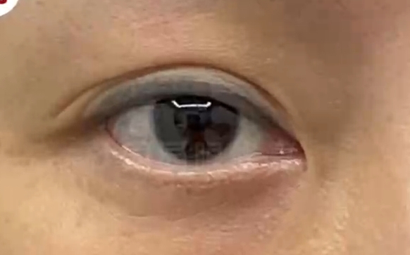 雙眼皮眼尾分叉，上妝易卡粉？看看杜園園醫(yī)生怎么說?