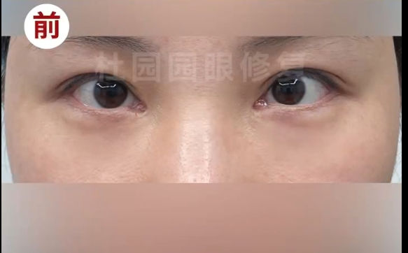 解密內(nèi)眼角圓形洞修復(fù)的奧秘：杜園園醫(yī)生的精湛技術(shù)