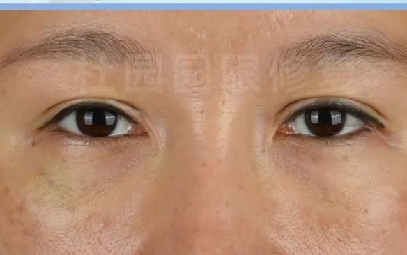 上海愛(ài)尚麗格專家教你應(yīng)對(duì)雙眼皮內(nèi)眼角失敗，消除疤痕明顯困擾