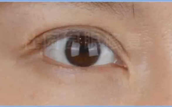 上海愛(ài)尚麗格內(nèi)眼角失敗修復(fù)技術(shù)，讓你的眼睛閃耀光彩