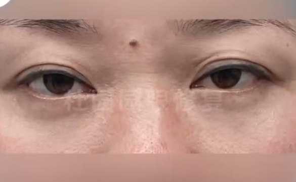 杜園園醫(yī)生揭秘：厭世眼如何實現(xiàn)眼神大改造？