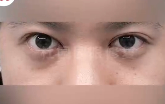 告別窄小雙眼，杜園園醫(yī)生幫你實現(xiàn)雙眼變美