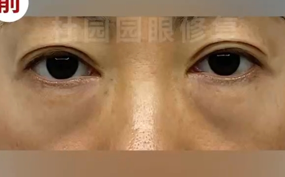 告別下眼瞼疤痕明顯，杜園園醫(yī)生為您還原嬌美雙眸