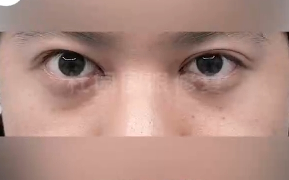 杜園園眼修復(fù)，打造美麗雙眼：告別雙眼皮過窄煩惱