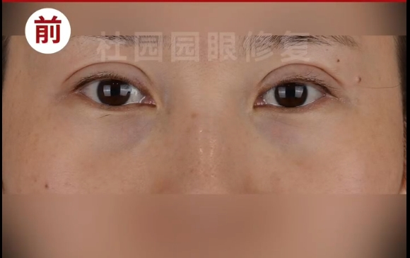 杜園園醫(yī)生修復(fù)案例：雙眼皮不去皮，寬降窄，恢復(fù)自信