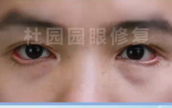 杜園園醫(yī)生的外眼角失敗修復(fù)案例分享