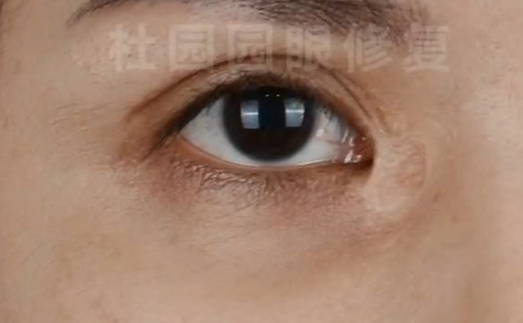 杜園園醫(yī)生內(nèi)眼角片狀疤痕修復(fù)，有問題的小伙伴可以參考下喲~