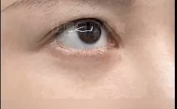 杜園園醫(yī)生的圓頓修復(fù)技術(shù)讓你擺脫外眼角困擾