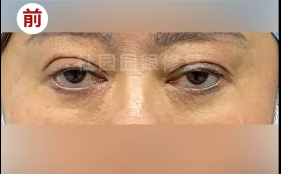 去眼袋失敗，下眼瞼退縮，這該怎么辦？看看杜園園醫(yī)生怎么修復(fù)