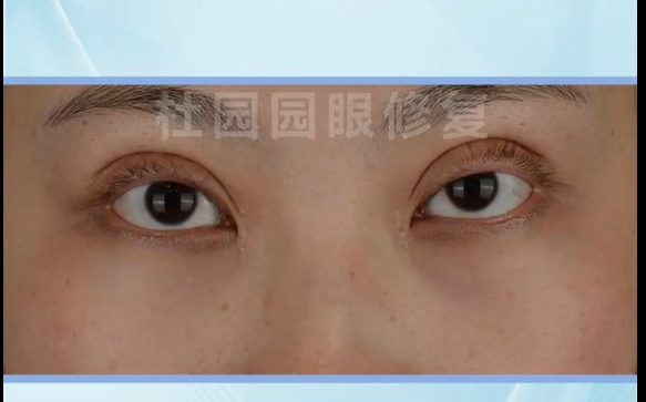 雙眼皮失敗怎么辦？上海愛(ài)尚麗格提肌撕脫修復(fù)解決你的煩惱！