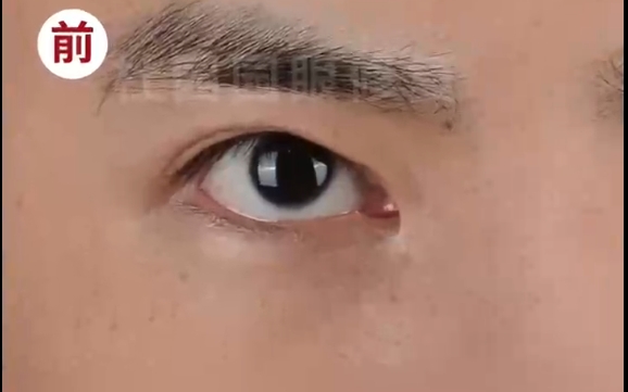 修復(fù)內(nèi)眼角豁口：杜園園醫(yī)生的雙眼皮松脫修復(fù)術(shù)，讓你重獲美麗