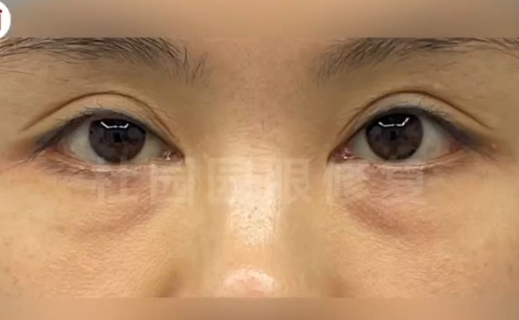 雙眼皮修復(fù)失敗，上海愛尚麗格杜園園眼修復(fù)案例參考