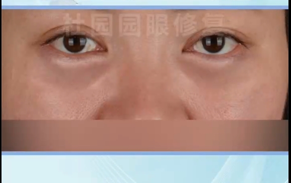 從4次眼袋失敗到成功煥新，杜園園醫(yī)生帶你重拾自信