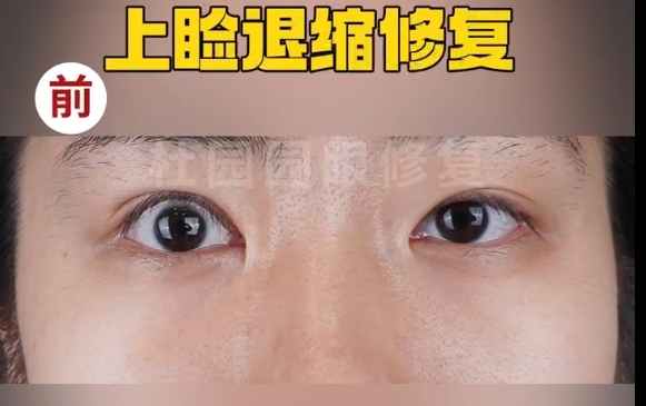 上瞼下垂失敗不再困擾！上海愛(ài)尚麗格專家?guī)鷮ふ医鉀Q方案