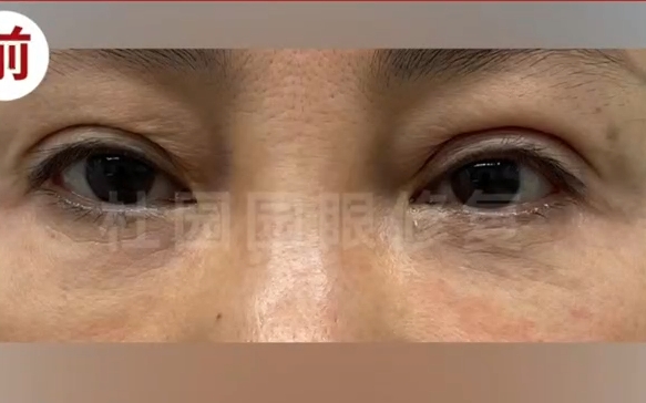 雙眼皮注射脂肪失敗再修復(fù)，杜園園醫(yī)生案例分享