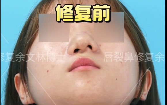 唇裂鼻修復(fù)：選擇合適的方法成就完美笑容