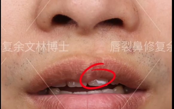 徹底告別唇裂困擾：余文林醫(yī)生唇裂修復(fù)案例分享 