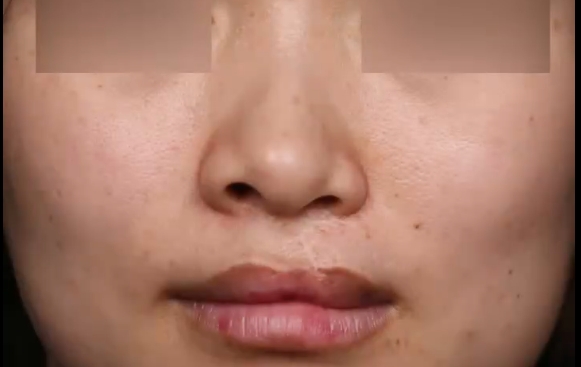 余文林醫(yī)生：重塑美麗，告別左側(cè)唇裂和鼻子輕微畸形