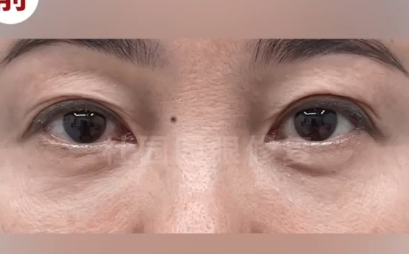 重塑雙眼魅力，上海愛(ài)尚麗格醫(yī)院雙眼皮多重褶皺修復(fù)解決方案