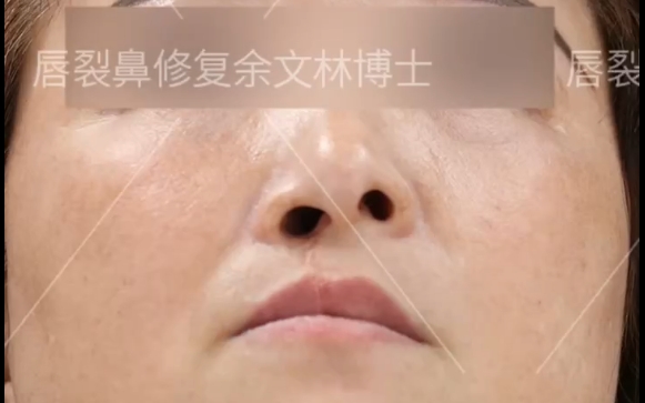 唇裂修復(fù)后，鼻子為什么還是歪的？余文林醫(yī)生詳解